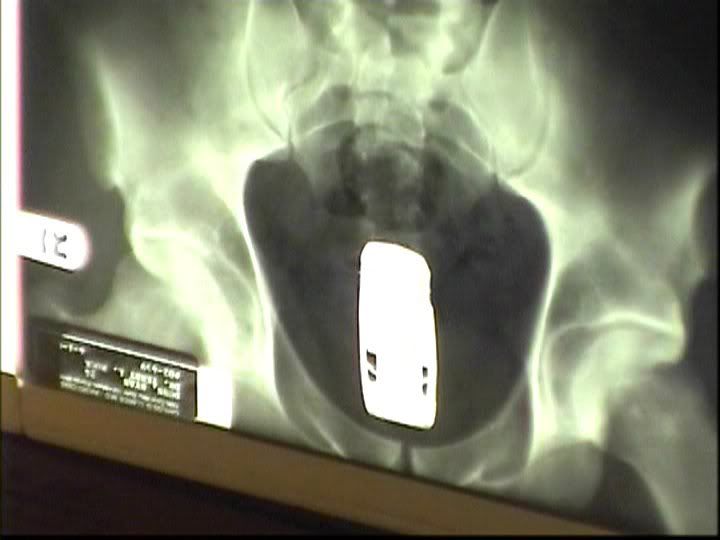 Scary XRay pictures (Warning not for weak hearted people)